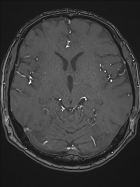 Cerebral arteriovenous malformation (Radiopaedia 84015-99245 Axial TOF 118).jpg