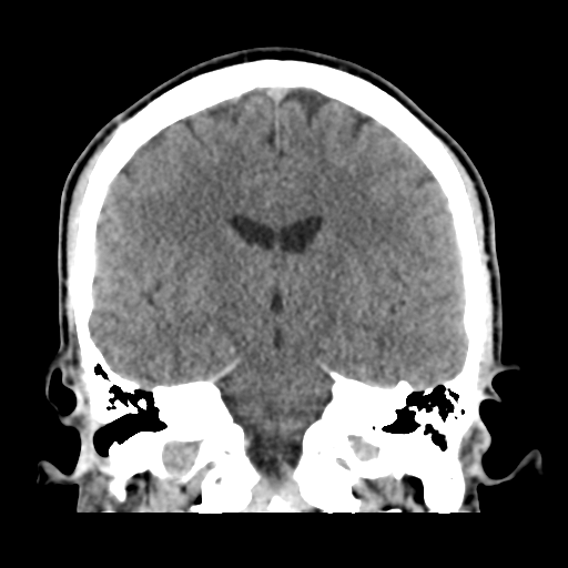 Cerebral arteriovenous malformation (Spetzler-Martin grade 2) (Radiopaedia 41262-44076 Coronal non-contrast 33).png