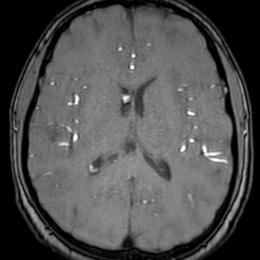 Cerebral arteriovenous malformation at posterior body of corpus callosum (Radiopaedia 74111-84925 Axial MRA 126).jpg