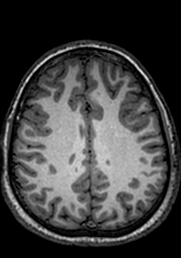 Cerebral arteriovenous malformation at posterior body of corpus callosum (Radiopaedia 74111-84925 Axial T1 85).jpg