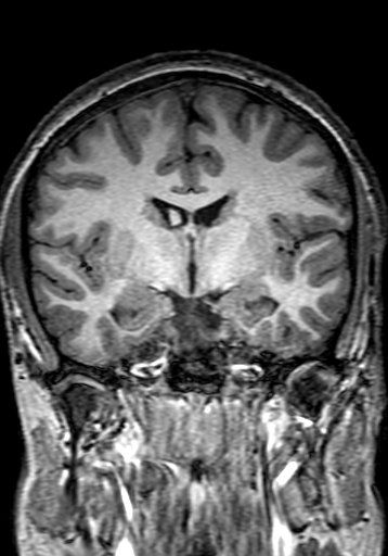 Cerebral arteriovenous malformation at posterior body of corpus callosum (Radiopaedia 74111-84925 Coronal T1 151).jpg