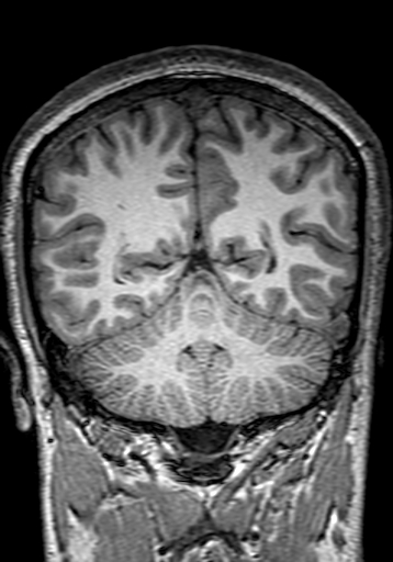Cerebral arteriovenous malformation at posterior body of corpus callosum (Radiopaedia 74111-84925 Coronal T1 248).jpg