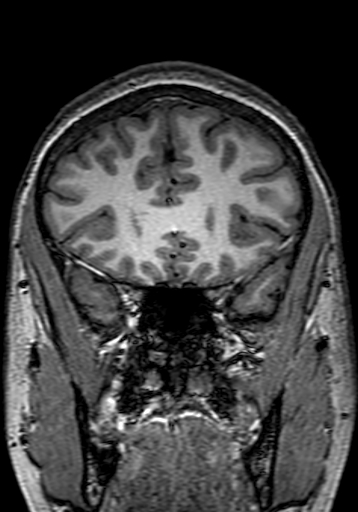 File:Cerebral arteriovenous malformation at posterior body of corpus callosum (Radiopaedia 74111-84925 Coronal T1 81).jpg