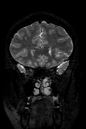 Cerebral arteriovenous malformation at posterior body of corpus callosum (Radiopaedia 74111-84925 Coronal T2 46).jpg