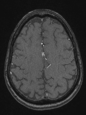 Cerebral arteriovenous malformation with hemorrhage (Radiopaedia 34422-35737 Axial MRA 65).png