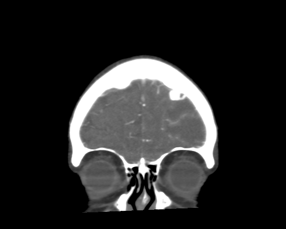 File:Cerebral arteriovenous malformation with lobar hemorrhage (Radiopaedia 44725-48511 A 9).png