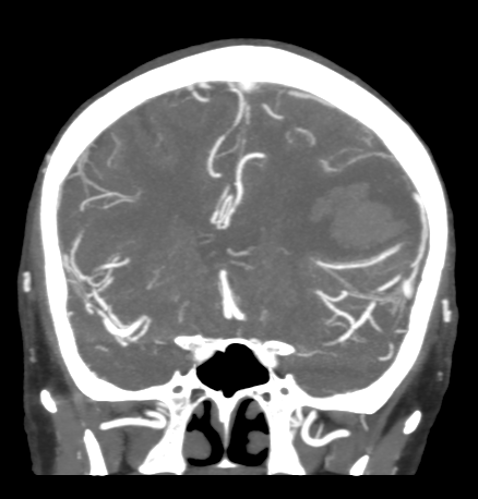 Cerebral arteriovenous malformation with lobar hemorrhage (Radiopaedia 44725-48511 B 22).png