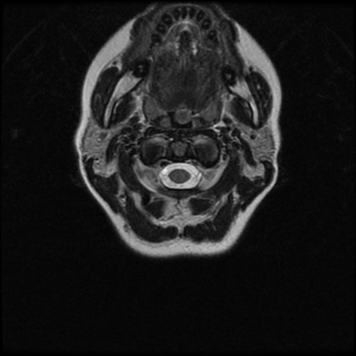 Cerebral autosomal dominant arteriopathy with subcortical infarcts and leukoencephalopathy (CADASIL) (Radiopaedia 41018-43763 Ax T2 C2-T1 28).png