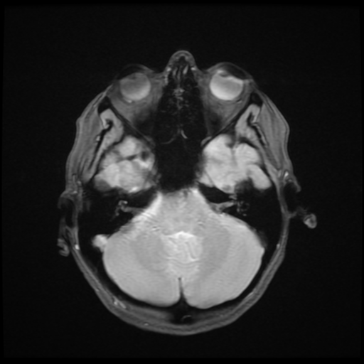 File:Cerebral autosomal dominant arteriopathy with subcortical infarcts and leukoencephalopathy (CADASIL) (Radiopaedia 41018-43768 Ax 2D MERGE 5).png