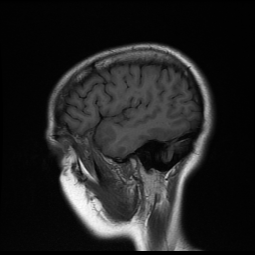 File:Cerebral autosomal dominant arteriopathy with subcortical infarcts and leukoencephalopathy (CADASIL) (Radiopaedia 41018-43768 Sagittal T1 17).png