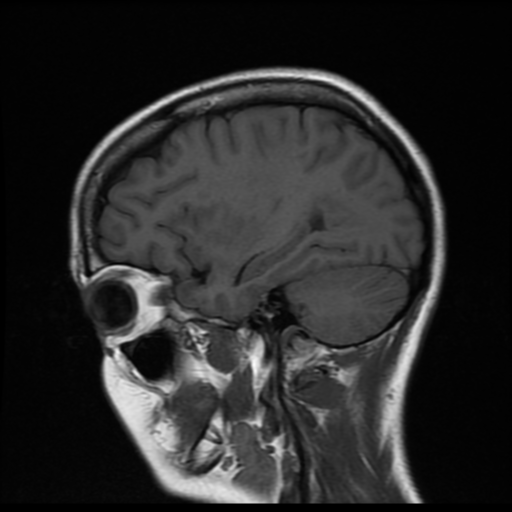 File:Cerebral autosomal dominant arteriopathy with subcortical infarcts and leukoencephalopathy (CADASIL) (Radiopaedia 41018-43768 Sagittal T1 6).png