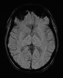 Cerebral cavernous venous malformation (Radiopaedia 70008-80021 Axial SWI 33).jpg