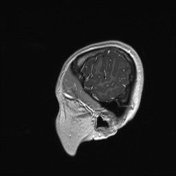 Cerebral cavernous venous malformation (Radiopaedia 70008-80021 Sagittal T1 C+ 67).jpg