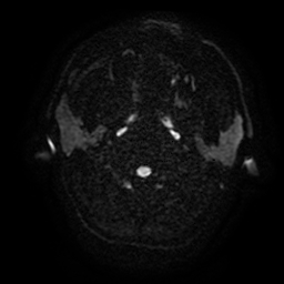 Cerebral cavernous venous malformation (Zabramski type II) (Radiopaedia 85511-101198 Axial DWI 34).jpg