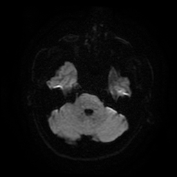 Cerebral cavernous venous malformation (Zabramski type II) (Radiopaedia 85511-101198 Axial DWI 43).jpg