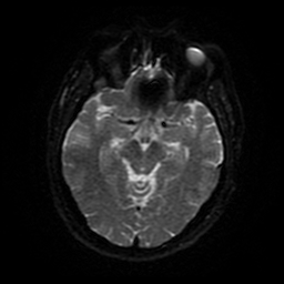 Cerebral cavernous venous malformation (Zabramski type II) (Radiopaedia 85511-101198 Axial DWI 80).jpg