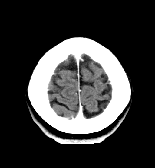 File:Cerebral cavernous venous malformations (Radiopaedia 48117-52945 Axial C+ delayed 30).png