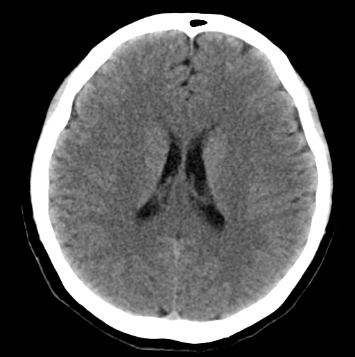 File:Cerebral cavernous venous malformations (Radiopaedia 48117-52945 Axial non-contrast 20).png