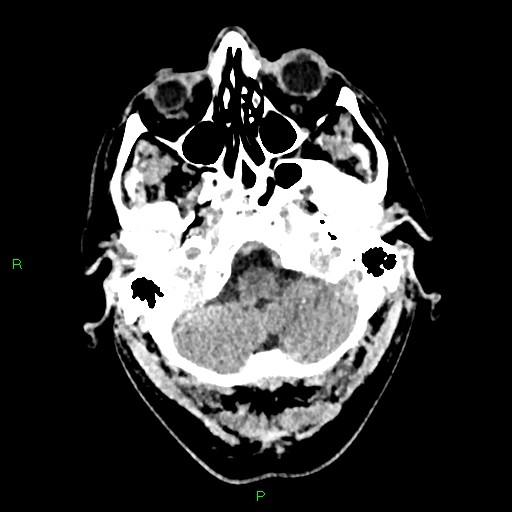 Cerebral contusions (Radiopaedia 33868-35039 Axial non-contrast 27).jpg