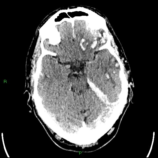 File:Cerebral contusions (Radiopaedia 33868-35039 Axial non-contrast 72).jpg
