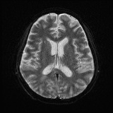 Cerebral embolic infarcts (embolic shower) (Radiopaedia 72391-82921 Axial DWI 17).jpg