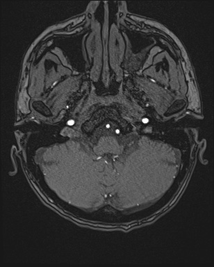 Cerebral embolic infarcts (embolic shower) (Radiopaedia 72391-82921 Axial MRA 9).jpg
