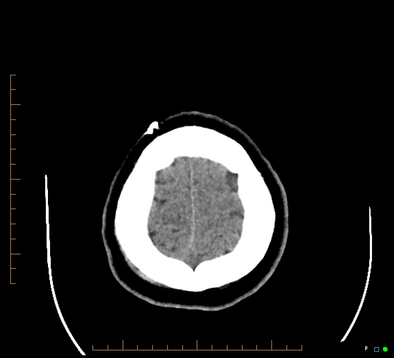 Cerebral fat embolism (Radiopaedia 85521-101220 Axial non-contrast 54).jpg