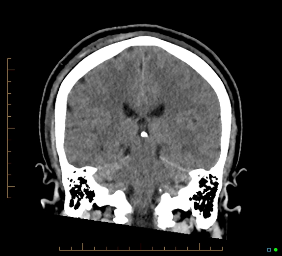 Cerebral fat embolism (Radiopaedia 85521-101224 Coronal non-contrast 39).jpg