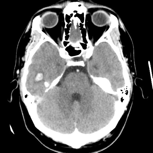 Cerebral hemorrhage secondary to arteriovenous malformation (Radiopaedia 33497-34561 B 17).png