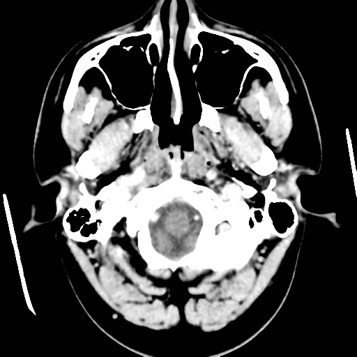 Cerebral hemorrhage secondary to arteriovenous malformation (Radiopaedia 33497-34561 B 7).png