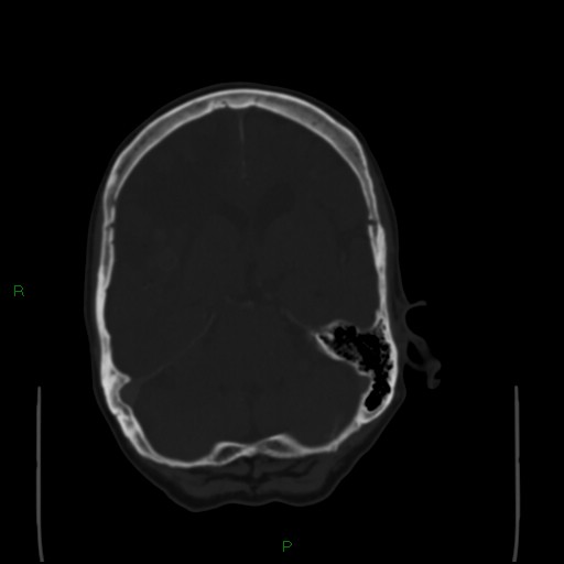 Cerebral metastases - breast primary (Radiopaedia 77653-89857 Axial bone window 44).jpg