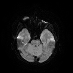 Cerebral metastases - melanoma (Radiopaedia 80972-94522 Axial DWI 11).jpg