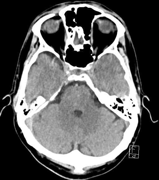 Cerebral metastases - testicular choriocarcinoma (Radiopaedia 84486-99855 Axial non-contrast 39).jpg