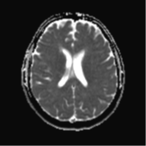 File:Cerebral metastases mimicking abscesses (Radiopaedia 45841-50131 Axial ADC 18).png