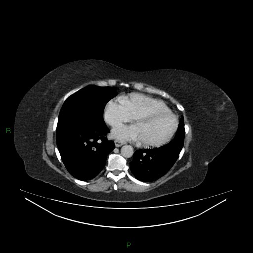 Cerebral metastasis from renal cell carcinoma (Radiopaedia 82306-96378 A 1).jpg