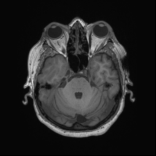 File:Cerebral metastasis to basal ganglia (Radiopaedia 81568-95413 Axial T1 19).png