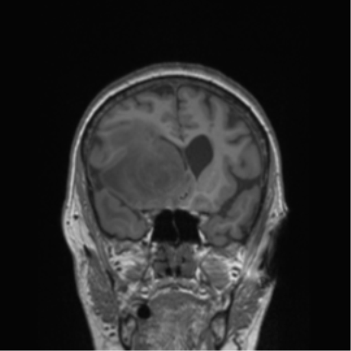 Cerebral metastasis to basal ganglia (Radiopaedia 81568-95413 Coronal T1 41).png