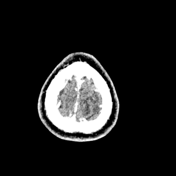 Cerebral toxoplasmosis (Radiopaedia 53993-60131 Axial C+ delayed 69).jpg