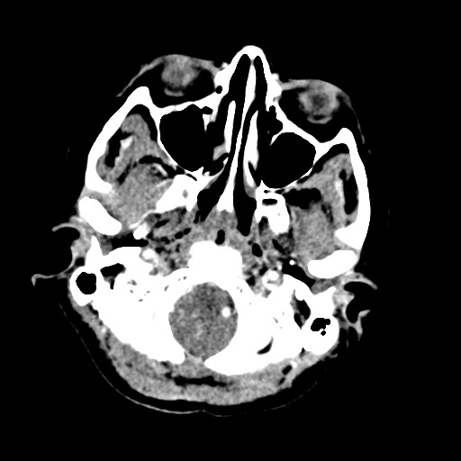Cerebral tuberculosis with dural sinus invasion (Radiopaedia 60353-68019 Axial C+ delayed 7).jpg