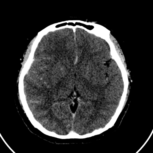Cerebral venous hemorrhagic infarct from venous sinus thrombosis (Radiopaedia 55433-61883 Axial C+ delayed 79).jpg