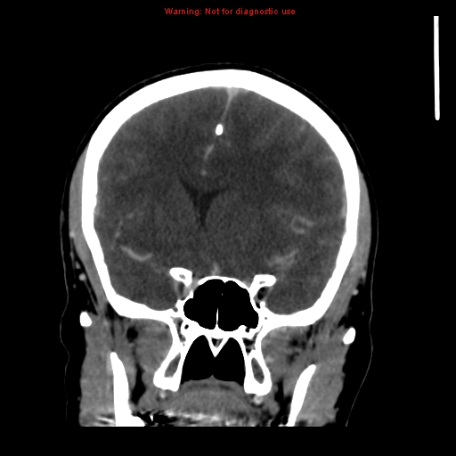 Cerebral venous infarction (Radiopaedia 12404-20735 B 30).jpg
