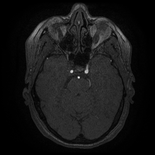 Cerebral venous infarction (Radiopaedia 25109-25363 MRA 9).jpg