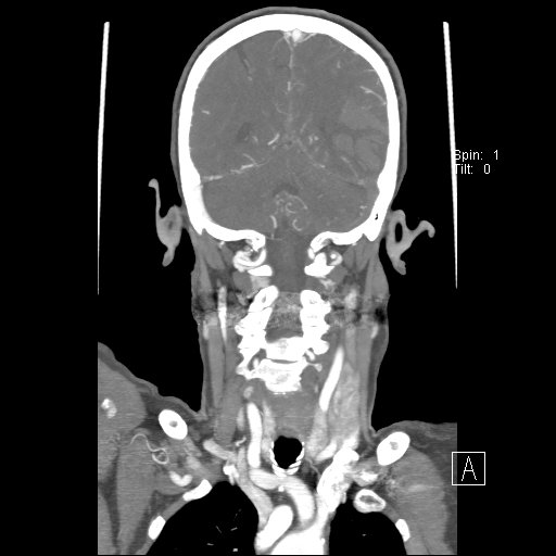 File:Cerebral venous infarction with hemorrhage (Radiopaedia 65343-74396 B 199).jpg