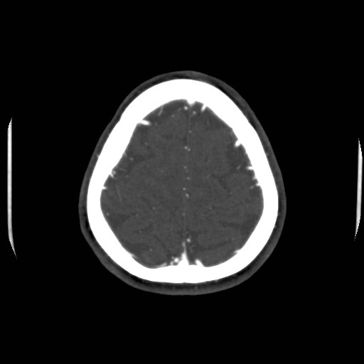 Cerebral venous sinus thrombosis (Radiopaedia 40619-43227 A 198).jpg