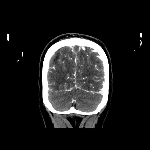 File:Cerebral venous throbmosis - hemorrhagic venous infarction (Radiopaedia 87318-103613 Coronal CT venogram 35).jpg