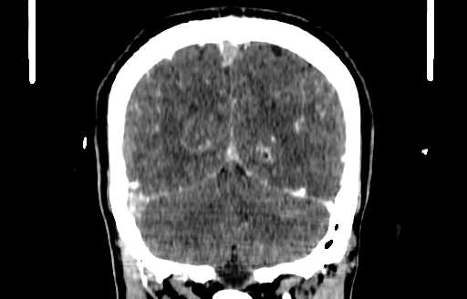 File:Cerebral venous thrombosis (CVT) (Radiopaedia 77524-89685 C 50).jpg