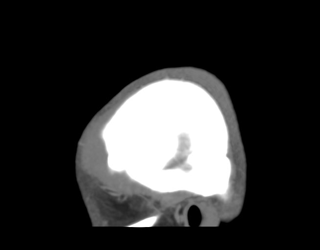 Cerebral venous thrombosis (Radiopaedia 38392-40467 D 4).png