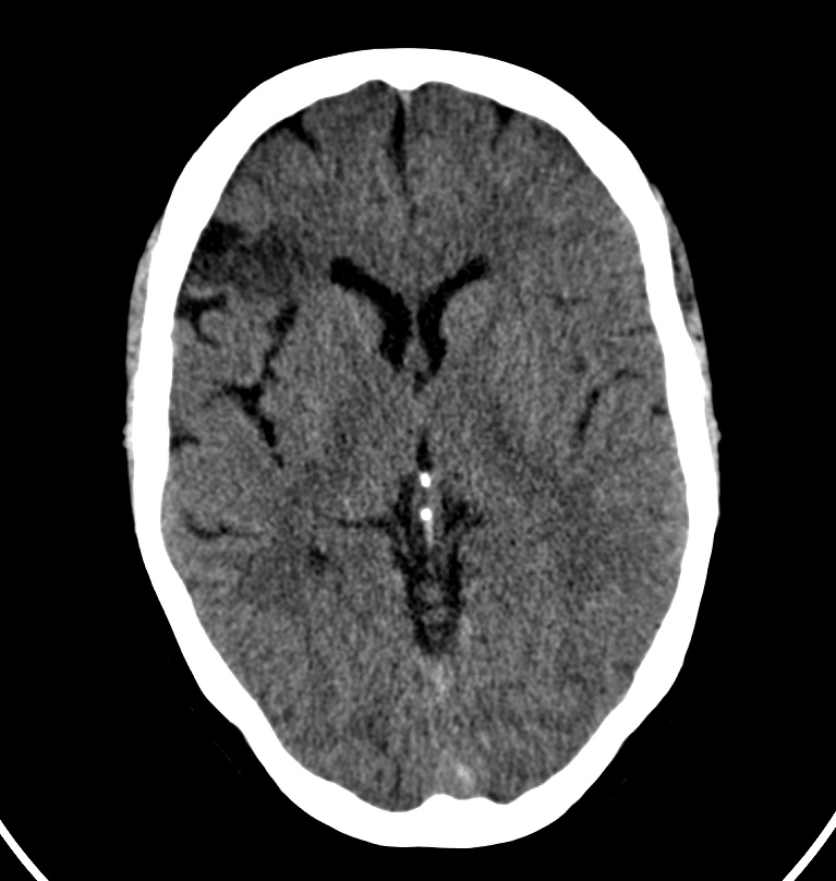Cerebral venous thrombosis - CT only (Radiopaedia 41031-43778 Axial non-contrast 44).jpg
