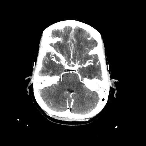 File:Cerebral venous thrombosis - hemorrhagic venous infarction (Radiopaedia 87318-103613 Axial 195).jpg