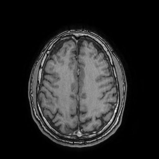 File:Cerebral venous thrombosis with secondary intracranial hypertension (Radiopaedia 89842-106957 Axial T1 C+ 126).jpg